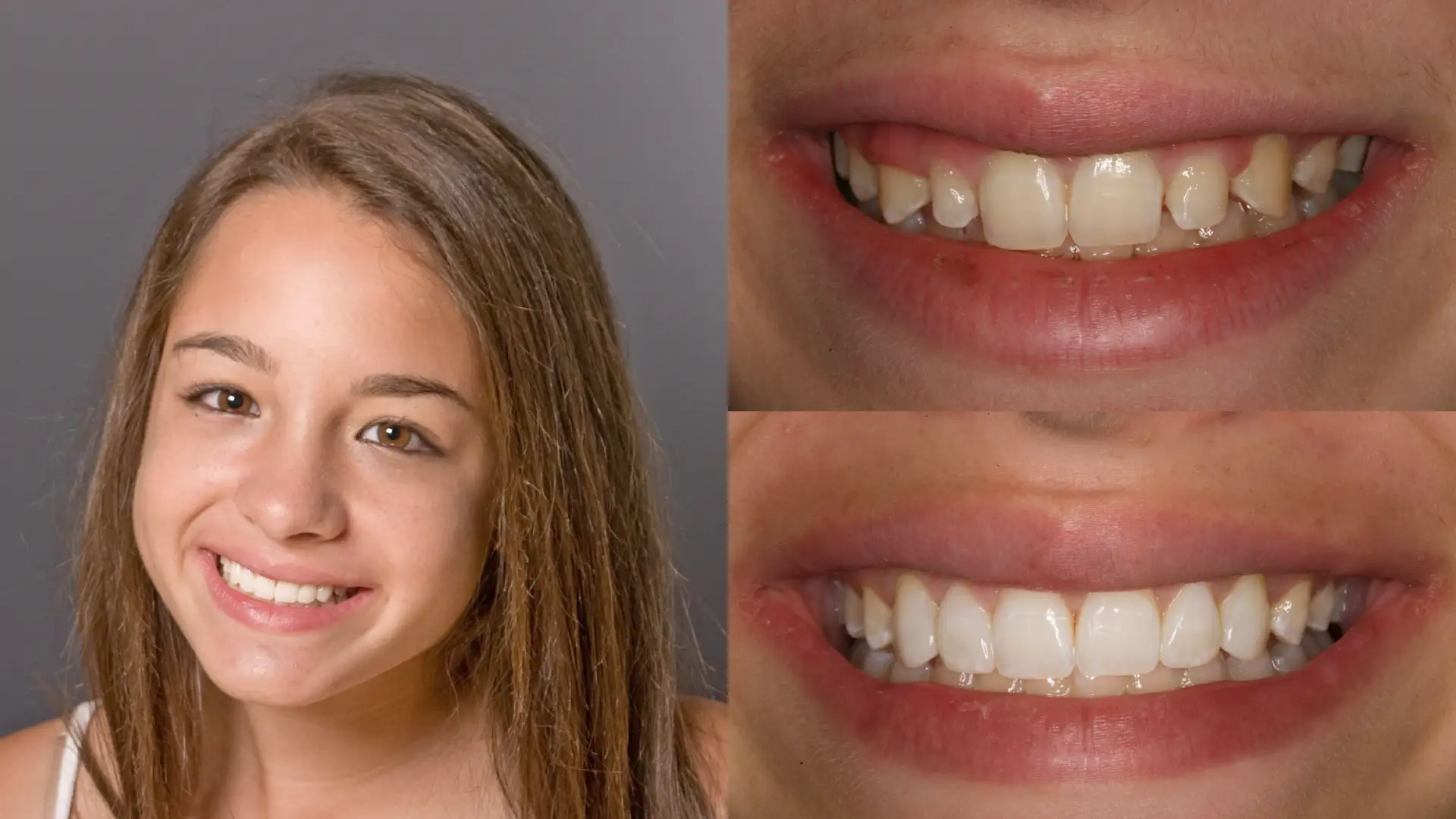 teeth-bonding-before-and-after-by-webmedies-com