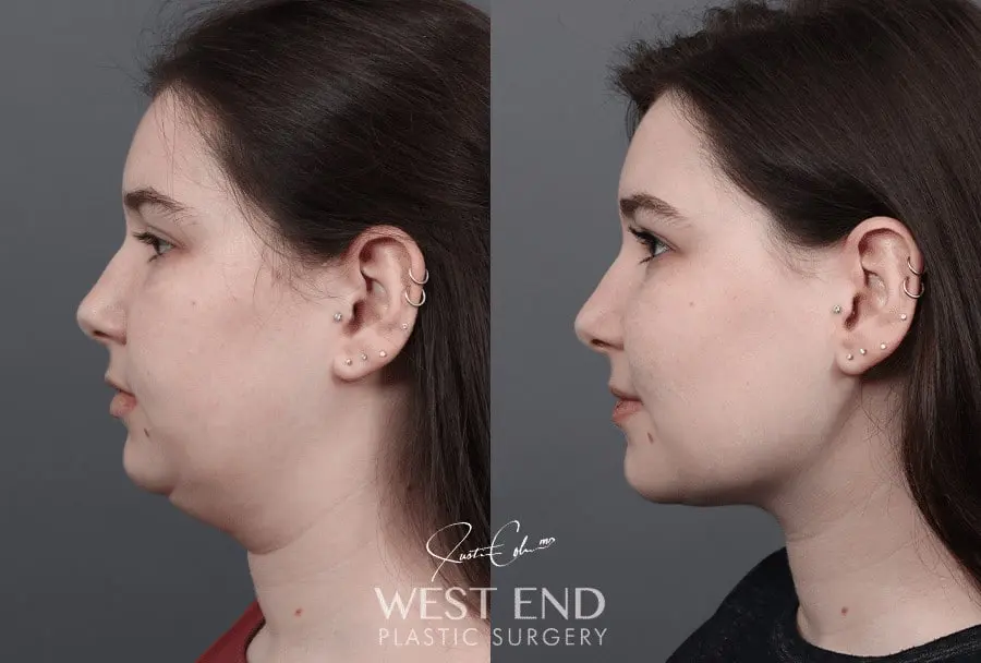 buccal-fat-pad-removal-before-and-after-results