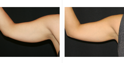 coolsculpting-before-after-by-webmedies-com