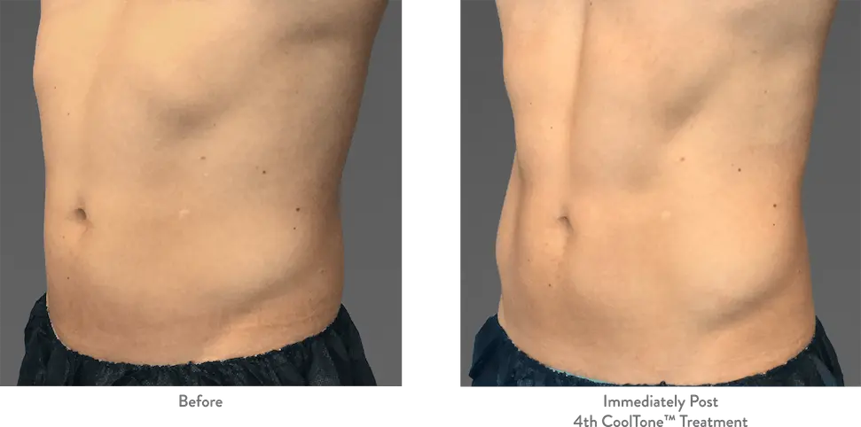 cool-tone-before-and-after-abdomen-photos-by-webmedies