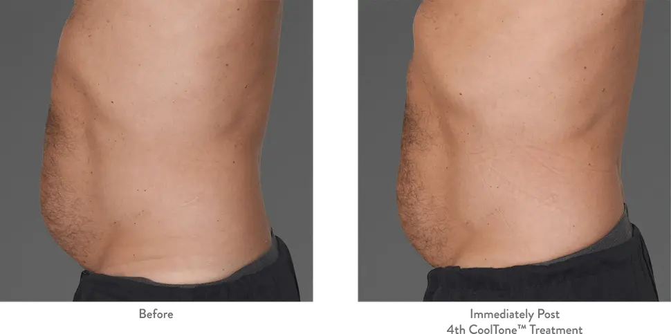 cooltone-before-and-after-abdomen-by-webmedies-com