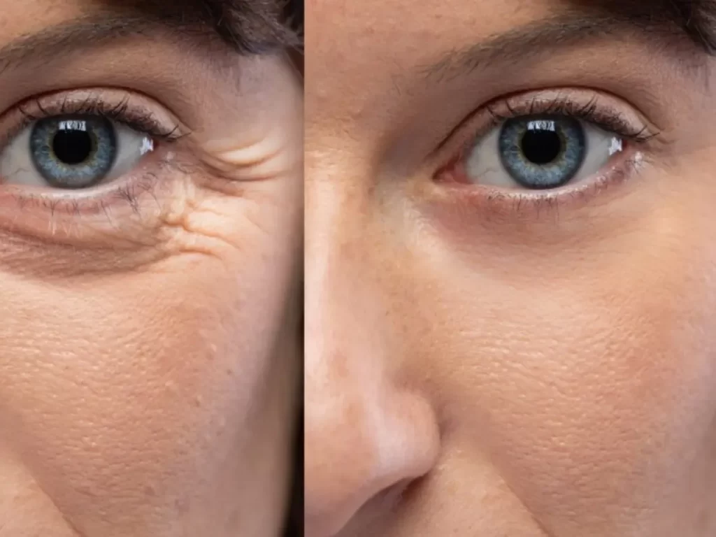 crows-feet-botox-before-and-after-webmedies-com