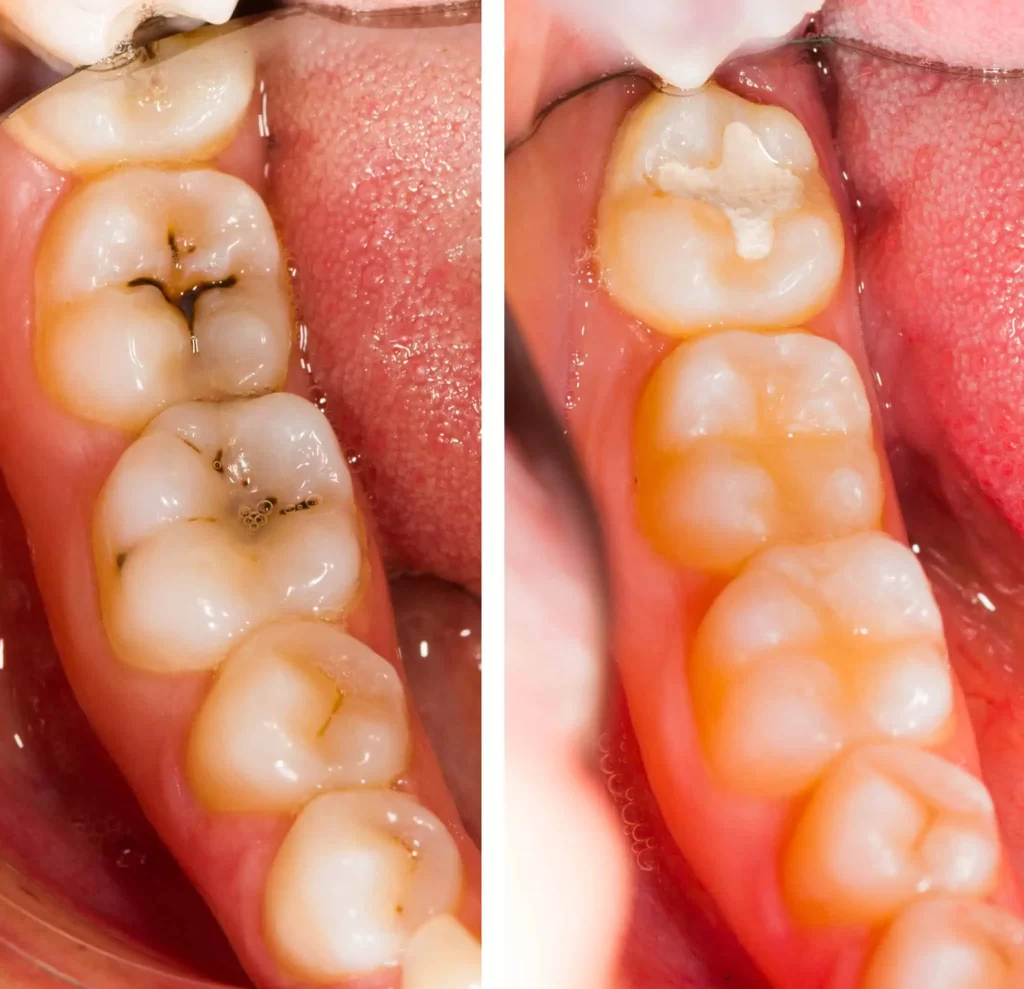 how-long-can-you-leave-a-cavity-untreated-by-webmedies