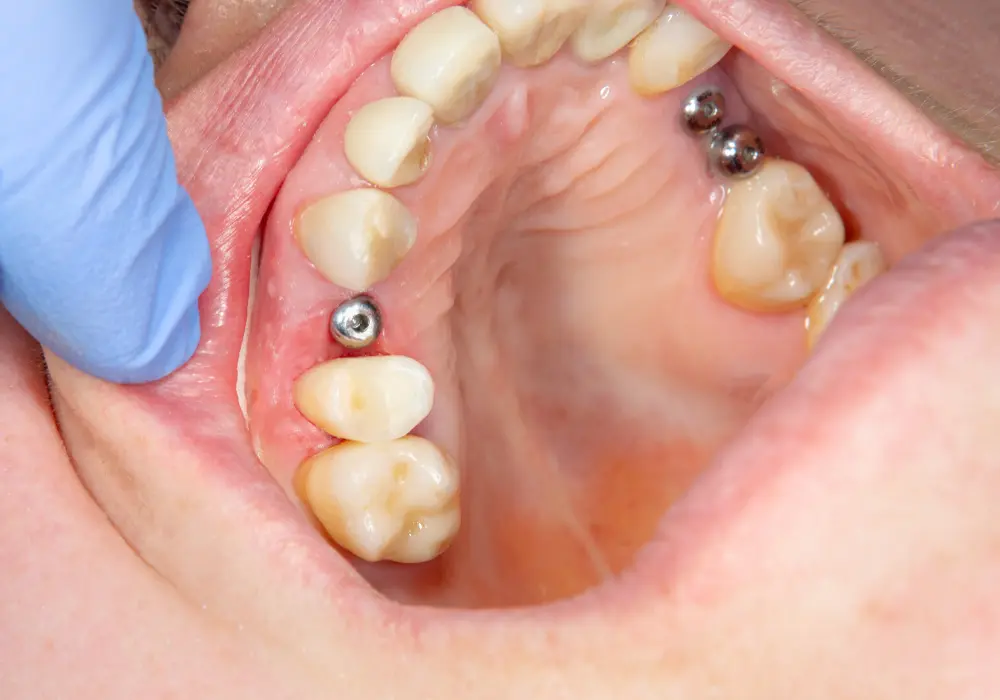 how-to-treat-dental-implant-infection-by-webmedies-com