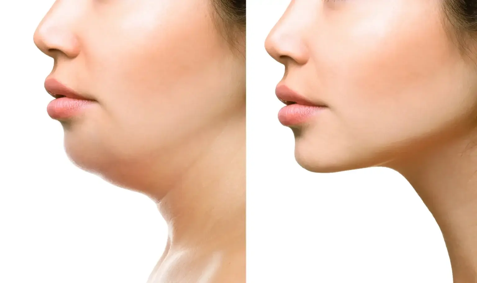 chin-before-and-after-results-webmedies-com