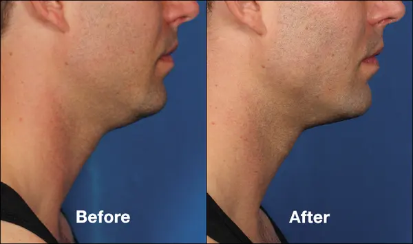 kybella-chin-patient-before-after-side-view-webmedies-com