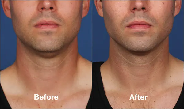 kybella-chin-patient-before-after-webmedies-com