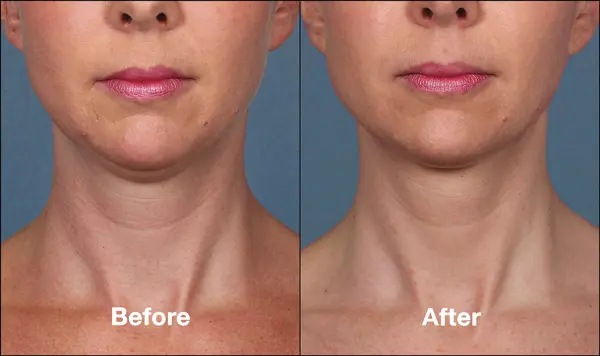 kybella-patient-before-after-front-view-webmedies-com