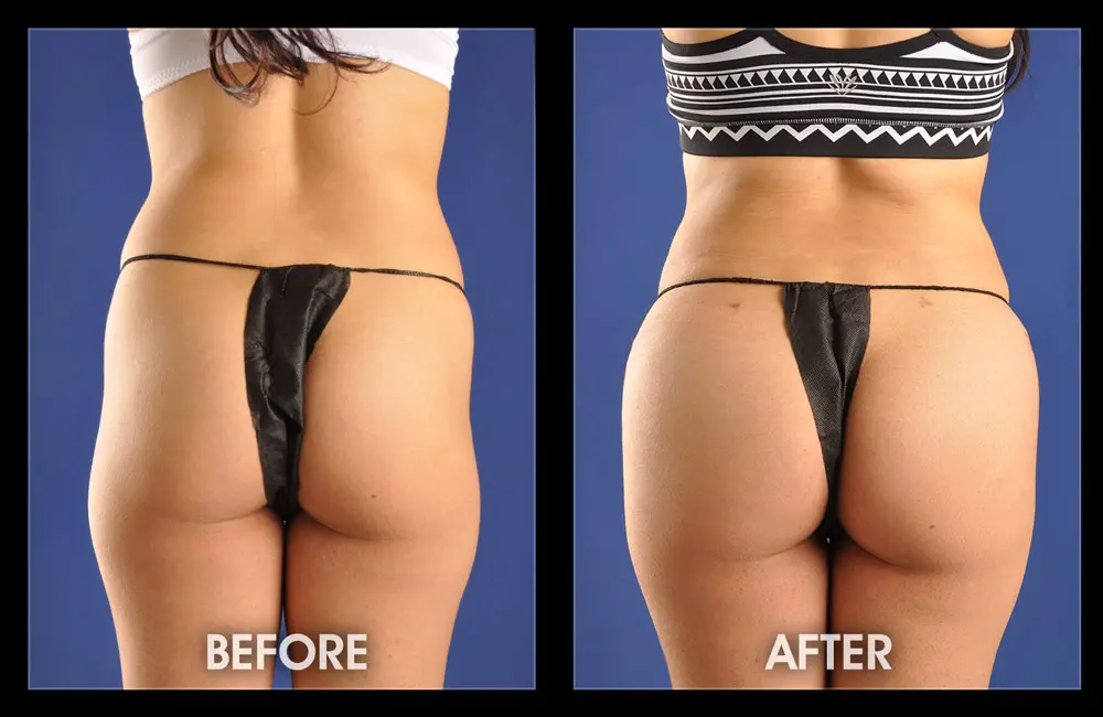 hip-dips-before-and-after-results